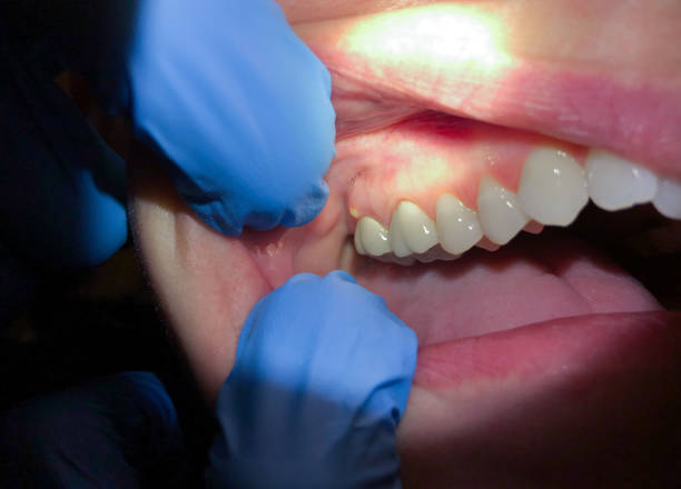 Best Urgent Care for Lost Fillings or Crowns in Fountain Hill, PA